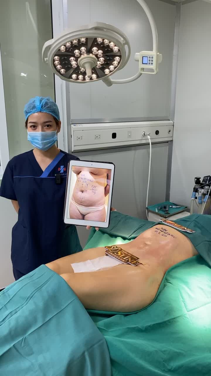 HÚT MỠ SIẾT EO 360