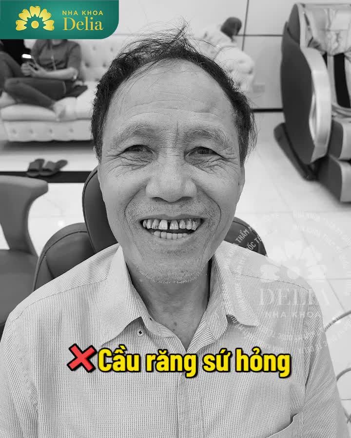 TRỒNG RĂNG IMPLANT ALL ON - KHÔI PHỤC RĂNG MẤT TOÀN DIỆN