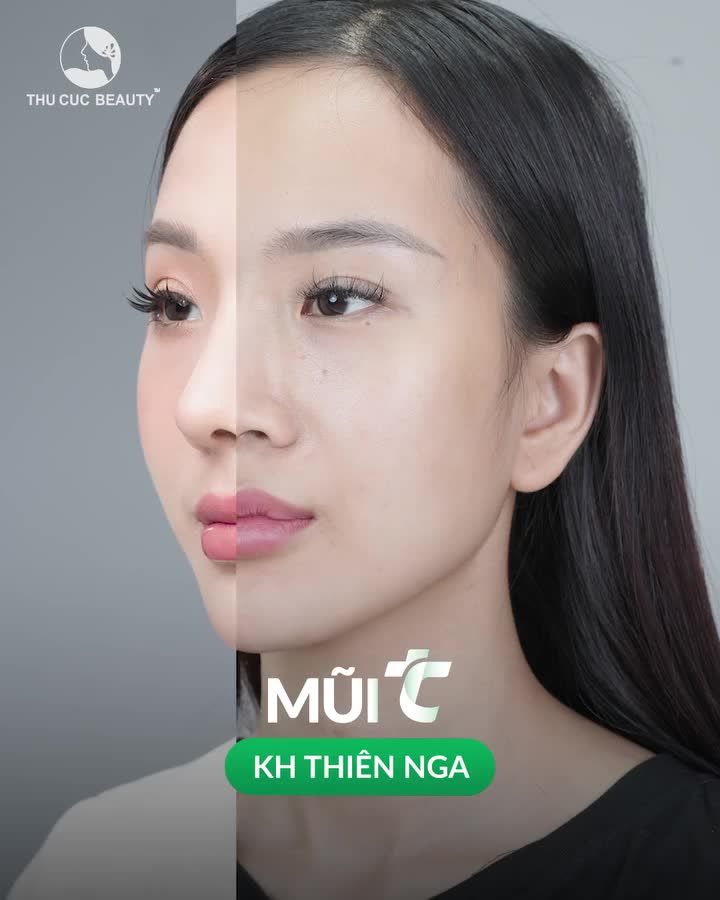 Đến TC Giảm ngay 35% cho 10 KH đăng ký nâng mũi ngay hôm nay