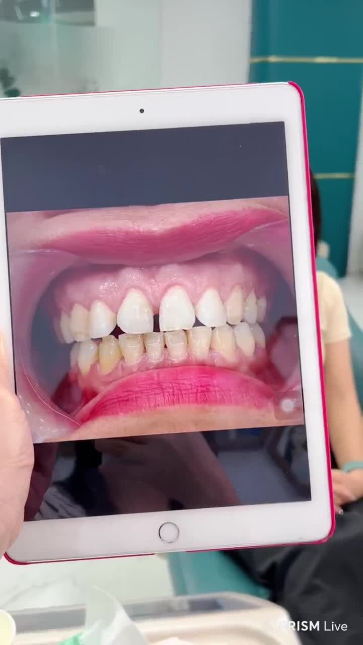 Chị khách hàng xinh đẹp quay lại tái khám sau 2 tuần lắp răng sứ thẩm mỹ
