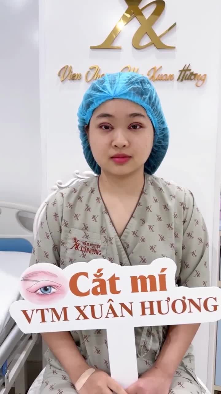 Cắt mí chỉnh cơ mi mở góc mắt ngay sau làm từ Dr Đình Quang, VTM Xuân Hương cho em khách genZ từ Thái Nguyên.