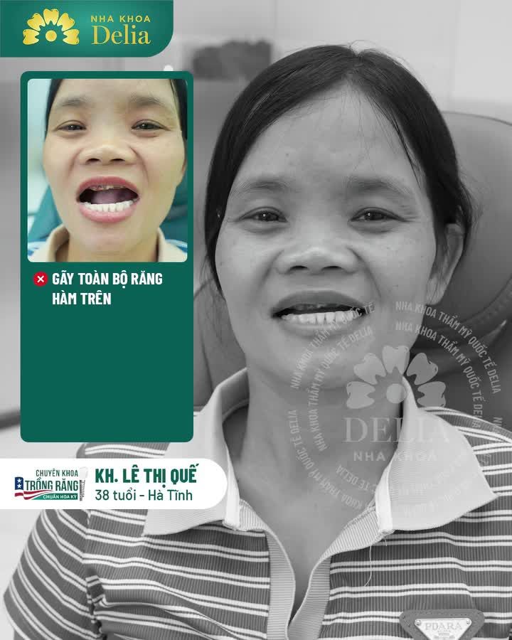 Mất TOÀN BỘ răng hàm trên ở tuổi 38