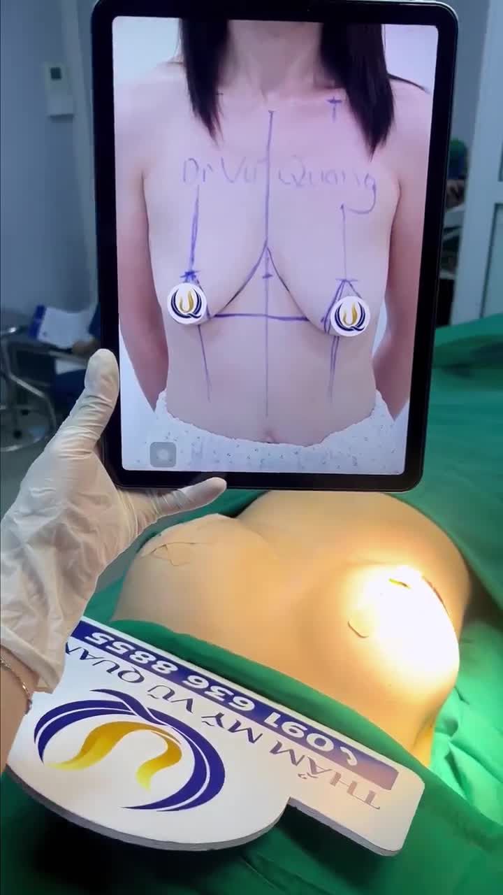 Kết quả nâng ngực cho khách hàng của Dr Vũ Quang
