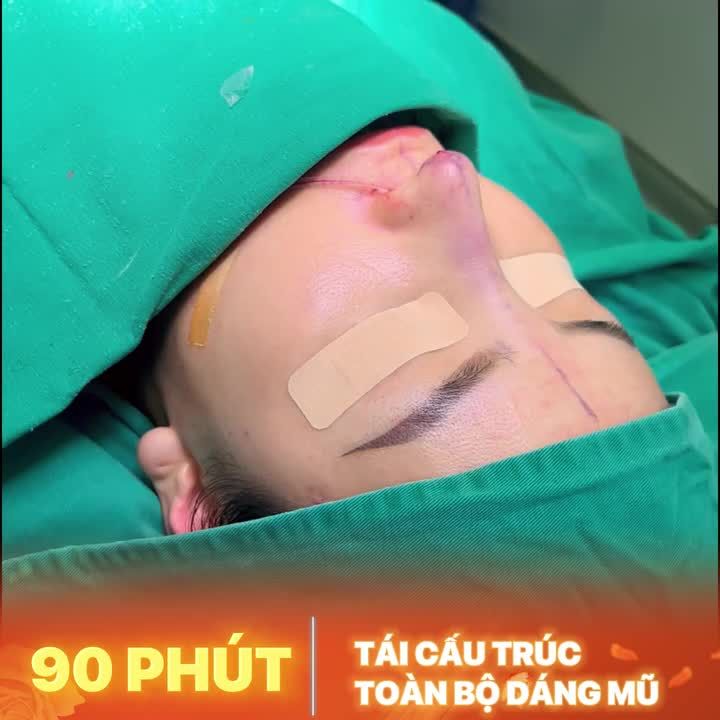 Bạn từng nâng mũi mà không ưng ý? Mất niềm tin vì nâng mũi hỏng?