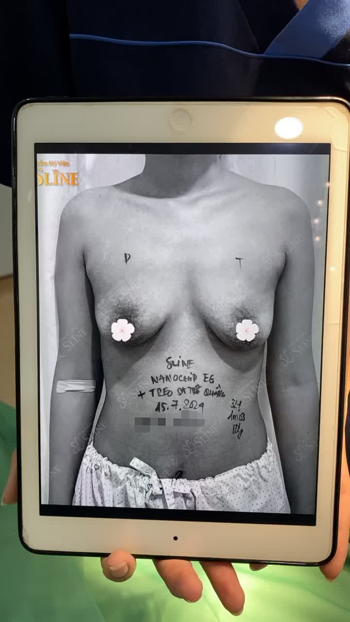 NANOCHIP EG + TREO SA TRỄ CHO KH 2 CON