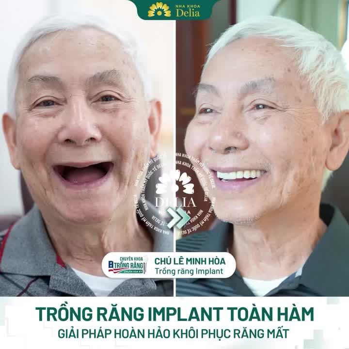 Trồng răng implant toàn hàm giải pháp HOÀN HẢO cho người mất răng