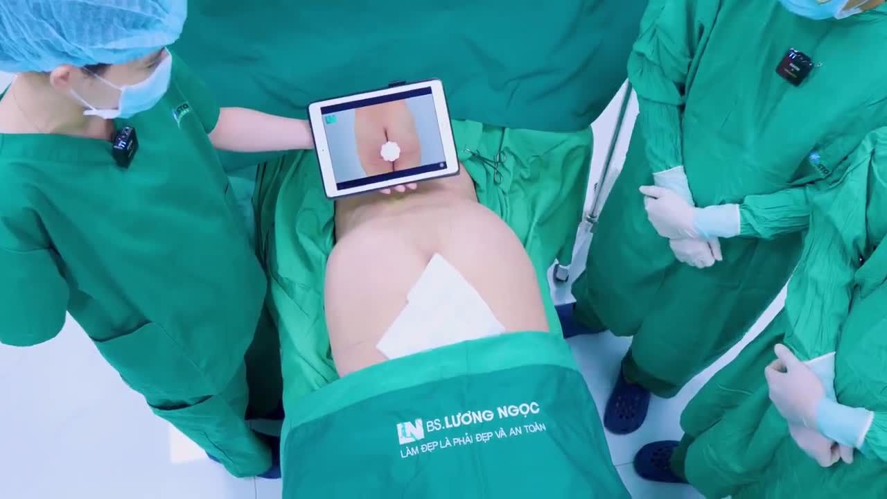  Tận dụng mỡ thừa lấy ra trong ca thực hiện  hút mỡ tạo dáng vùng bụng,