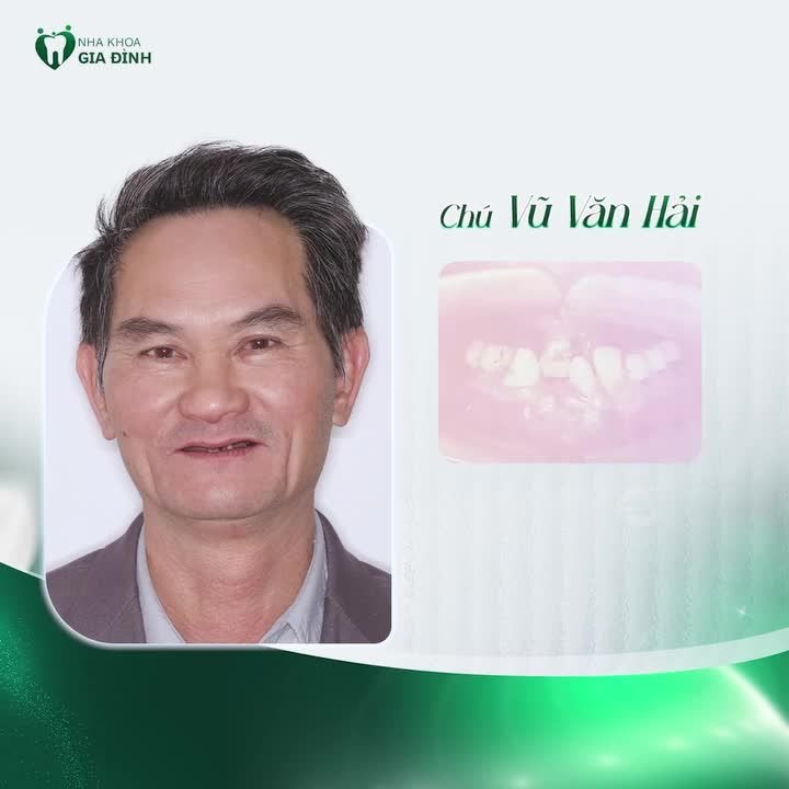 TOP 3 CÔ CHÚ CẤY GHÉP IMPLANT TOÀN HÀM THÀNH CÔNG TẠI NHA KHOA GIA ĐÌNH