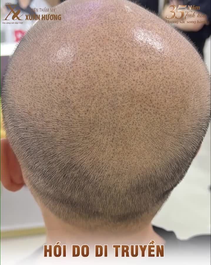 Loại bỏ nỗi ám ảnh hói đầu nhờ phương pháp vi chạm sắc tố da đầu SMP - công nghệ nổi tiếng tại Hàn Quốc chuyển giao chính hãng tại VTM Xuân Hương