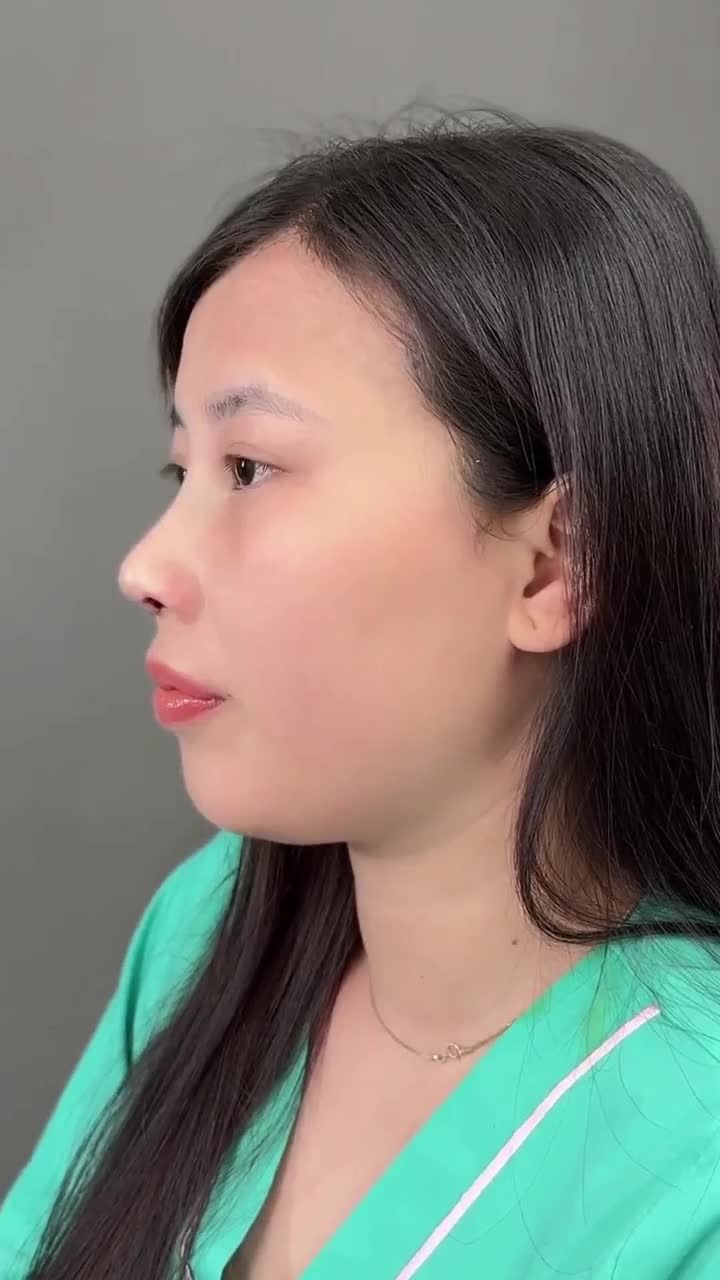 Nâng mũi cấu trúc sụn Bioform vừa hoàn thành cho bạn gái đến từ Đồng Nai!!