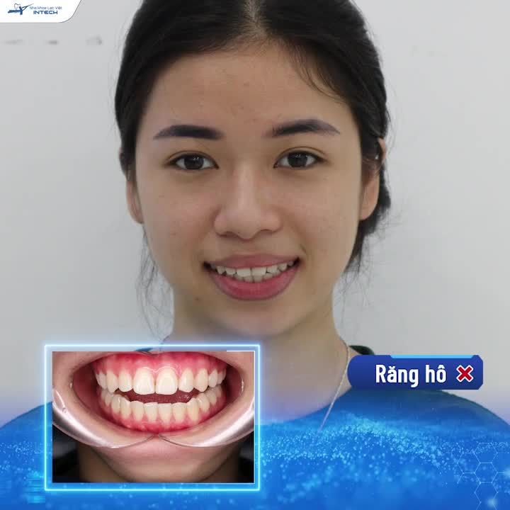 NGÀY HÔM NAY THẬT ĐẸP TRỜI, MÌNH BẮT ĐẦU NIỀNG RĂNG THÔI!