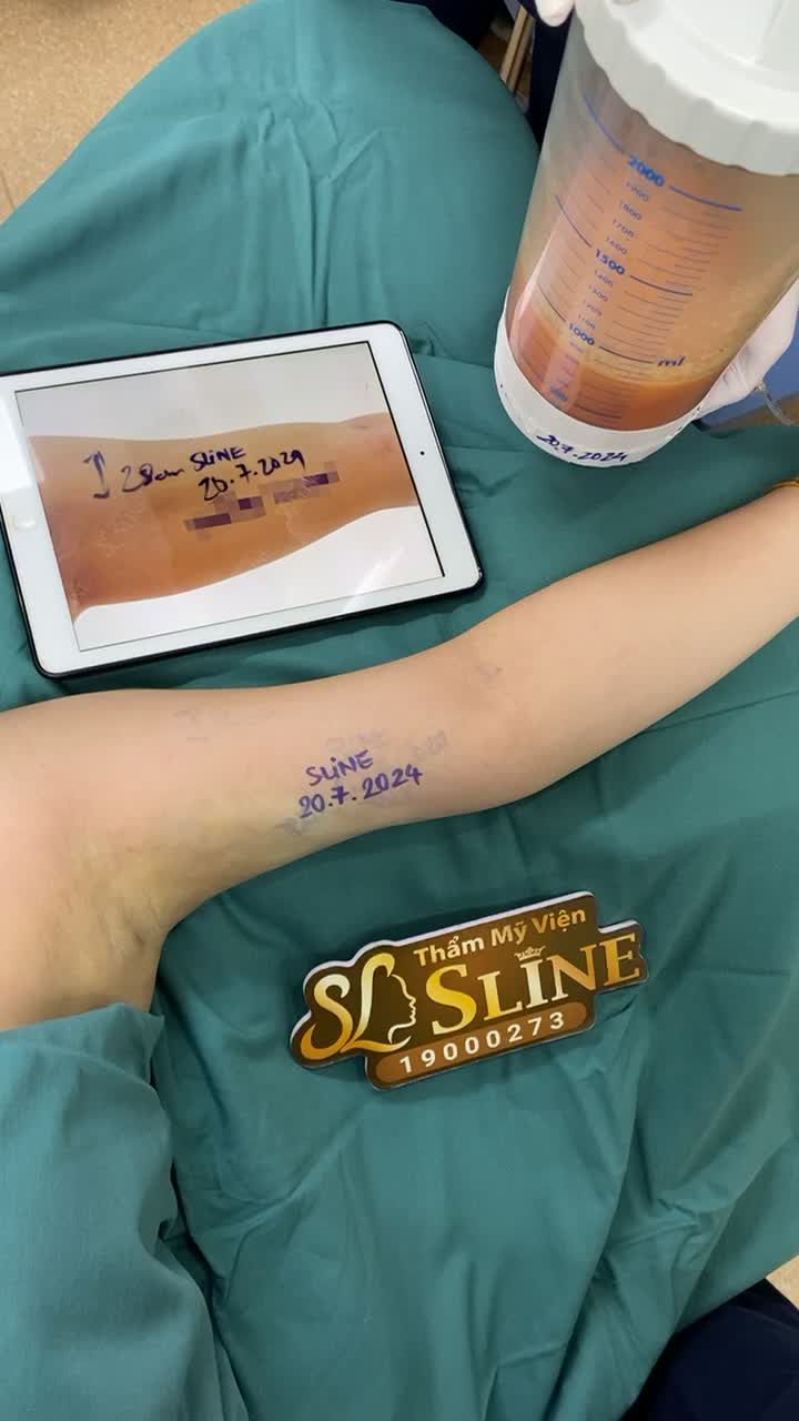 CÁNH TAY TO ĐÃ CÓ SLINE LO