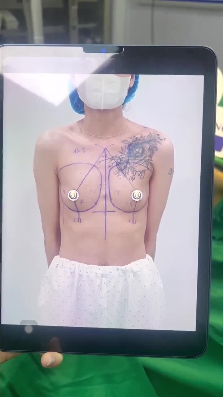 Kết quả nâng ngực cho khách hàng của Bác Sĩ Vũ Quang