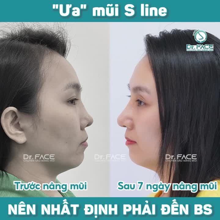 "Ưa" Mũi S Line Nên Nhất Định Phải Đến Bác Sĩ️