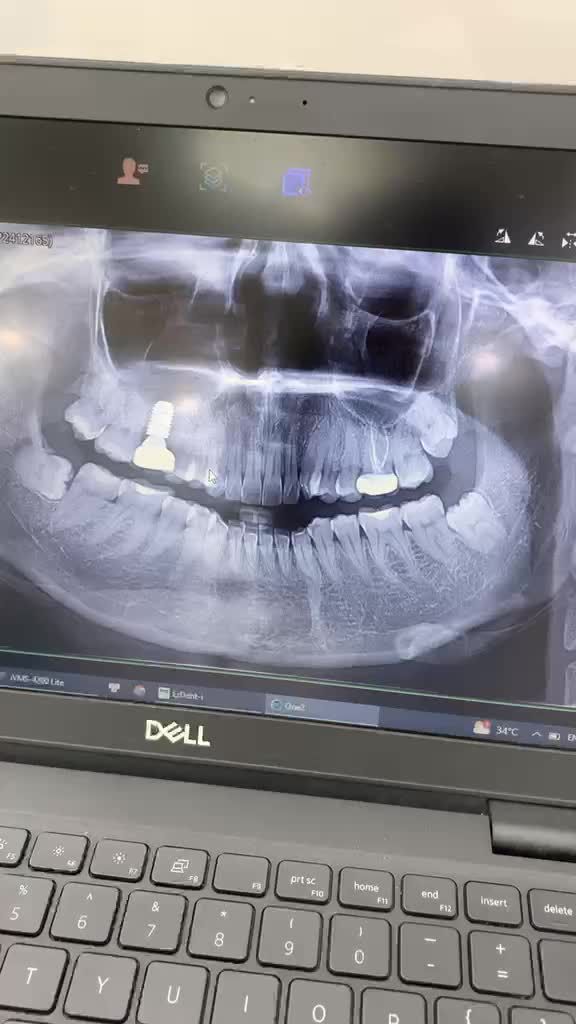 Nhổ răng khôn không đau bằng công nghệ nhổ máy Piezotome tại Nha Khoa Quốc Tế Việt Pháp cơ sở 358 Lacasta Chân Tháp Đồng Hồ Văn Phú - Hà Đông