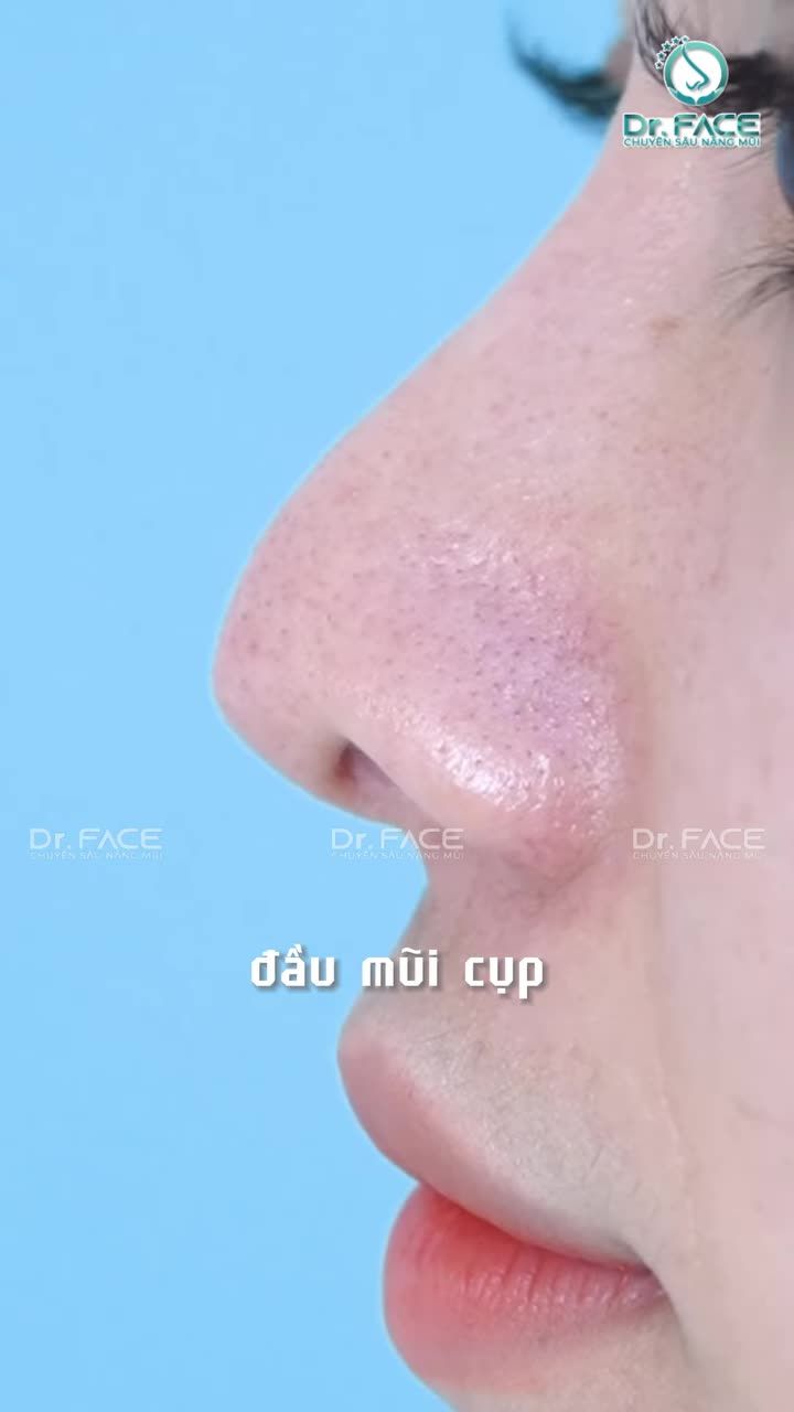 MŨI CỤP bị chê hoài mấy ní ơi!