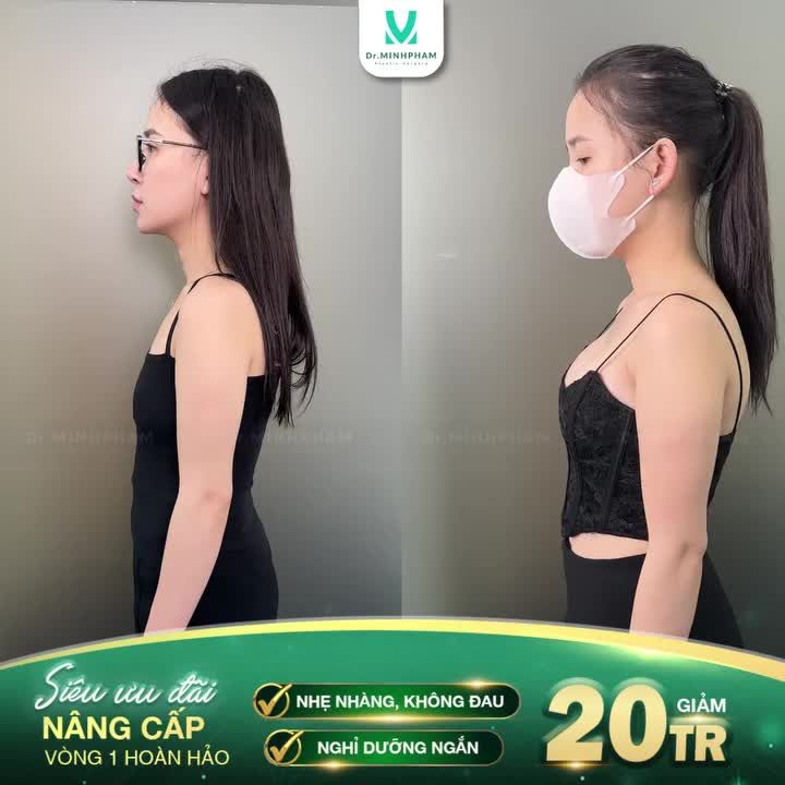 KẾT QUẢ NGOẠN MỤC SAU 3 TUẦN NÂNG NGỰC