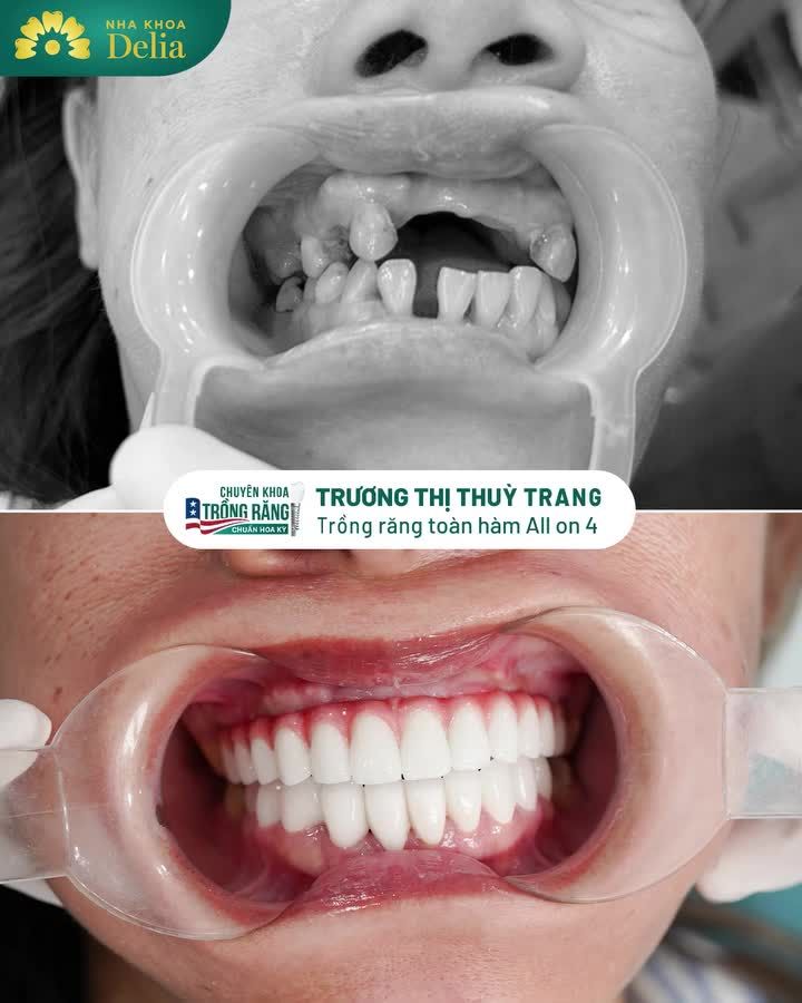 Trồng răng implant toàn hàm, tìm lại nụ cười khỏe đẹp