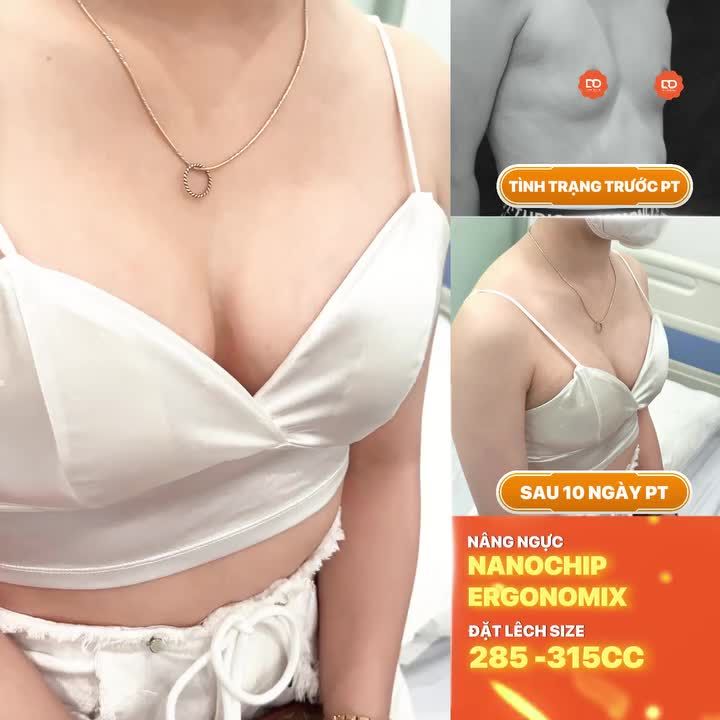 Before - After chỉ sau 10 ngày của chị khách hàng Nâng cấp V1 Nanochip Ergonomix