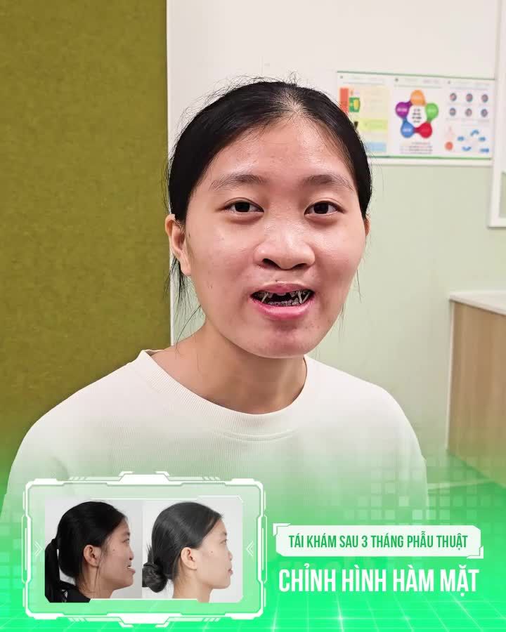 "Ăn nhai dễ hơn, khuôn mặt cân đối hơn" - Đó là cảm nhận của Thu Hương sau 03 tháng chỉnh hình hàm mặt tại Hồng Ngọc.