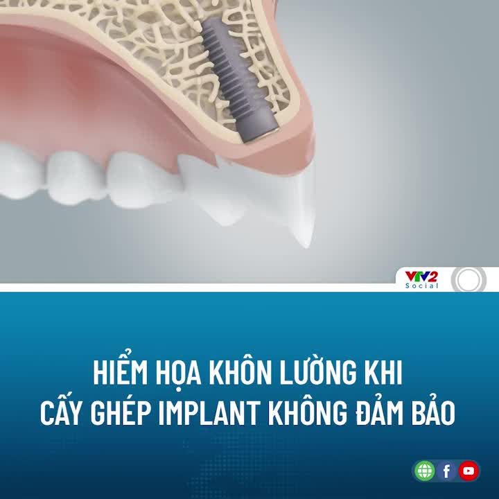 Trồng răng Implant là giải pháp khôi phục răng mất tối ưu nhất hiện nay.