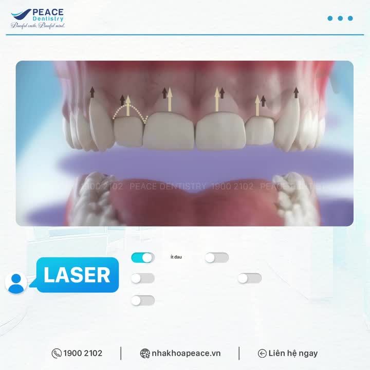 LASER CẢI THIỆN CƯỜI HỞ LỢI HIỆU QUẢ, NHẸ NHÀNG VÀ NHANH CHÓNG