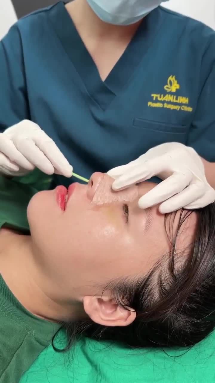 Cắt chỉ tái khám mũi sau 10 ngày nâng cấu trúc!!