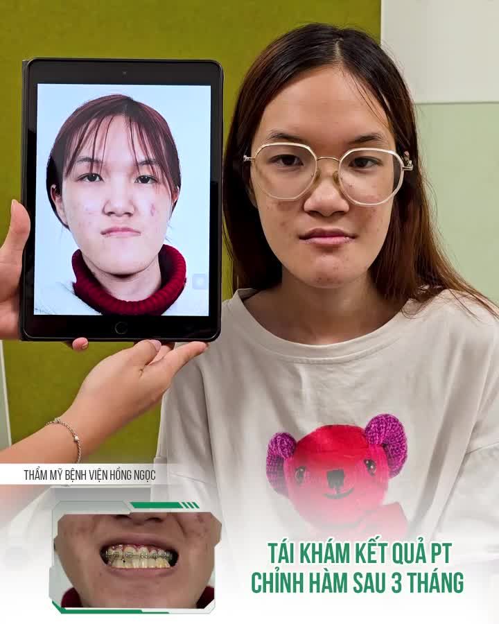 BẤT NGỜ VỚI DIỆN MẠO MỚI SAU 3 THÁNG PT CHỈNH HÀM
