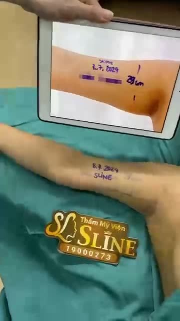 TAY THON VỚI HÚT MỠ CÁNH TAY BẰNG VASER LIPO