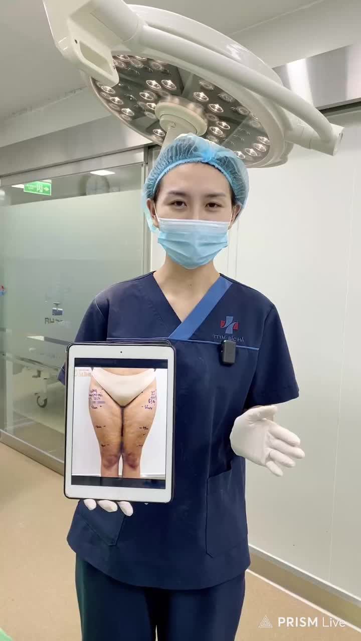 KẾT QUẢ HÚT MỠ ĐÙI
