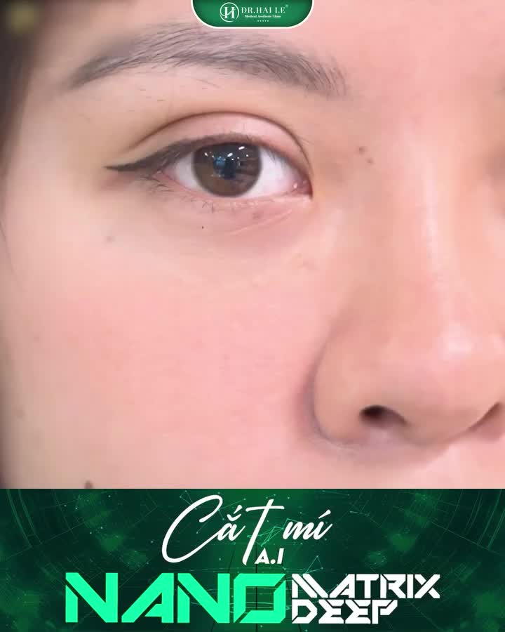 Phương pháp cắt mí An toàn - Hiệu quả - Lâu dài