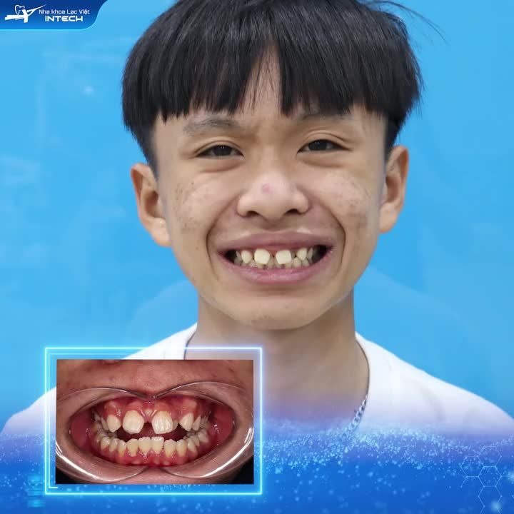 RĂNG THƯA THAY ĐỔI NHƯ THẾ NÀO SAO 2 NĂM NIỀNG RĂNG ?