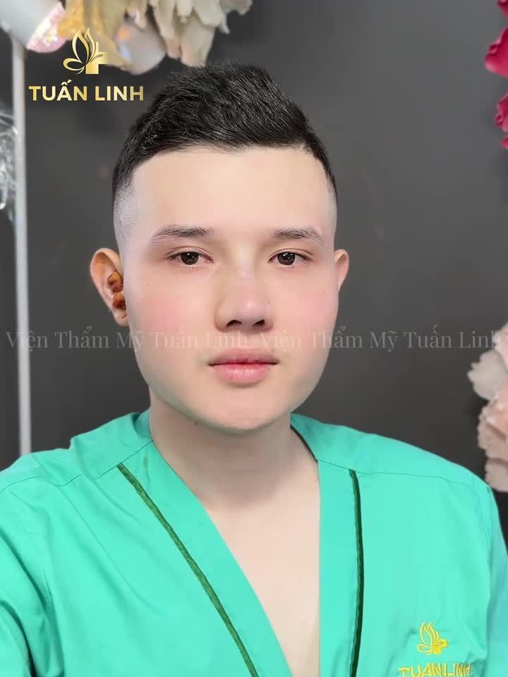 CHỈ VỚI 17TRIỆU - SỞ HỮU NGAY DÁNG MŨI CHUẨN NAM THẦN!!