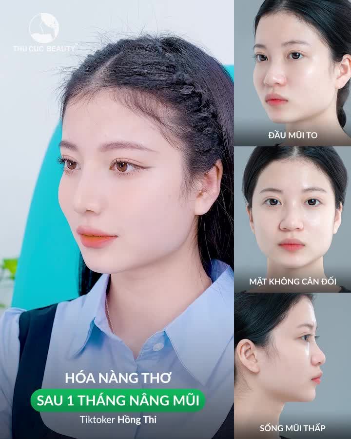Liệu nâng mũi có phải quyết định đúng đắn?