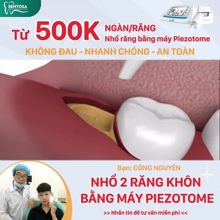 KHÔNG MỘT ĐỘNG TÁC THỪA, SAU 10 PHÚT TẠM BIỆT RĂNG KHÔN MỌC LỆCH