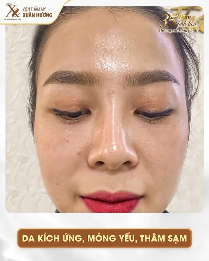 Meso Boost phục hồi tái tạo làn da không xâm lấn, làm 1 lần đẹp cả năm!
