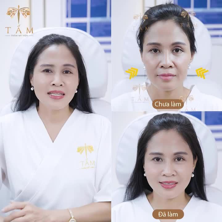 Filler đầy má, thái dương – Trẻ hoá thần tốc, hết hốc hác già nua