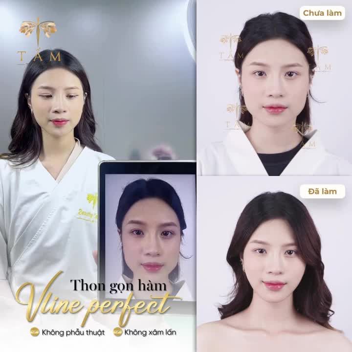 Hết mặt vuông, hàm bạnh to chỉ sau 1 liệu trình Vline Perfect