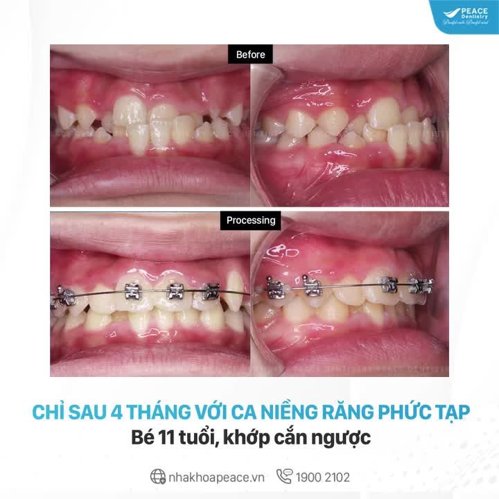 CHỈ SAU 4 THÁNG VỚI CA LÂM SÀNG CHỈNH NHA PHỨC TẠP Bé 11 tuổi, khớp cắn ngược