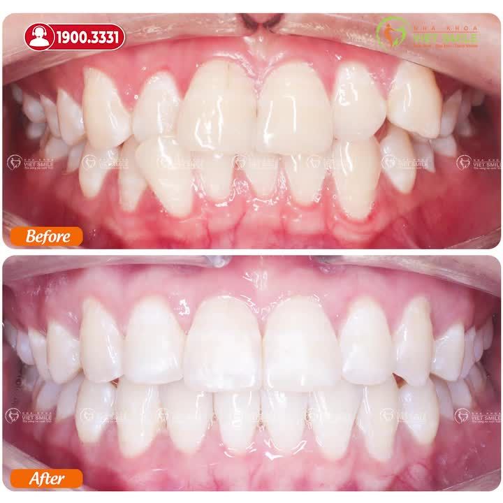 THẬT TUYỆT VỜI KHI CHỌN NIỀNG RĂNG INVISALIGN