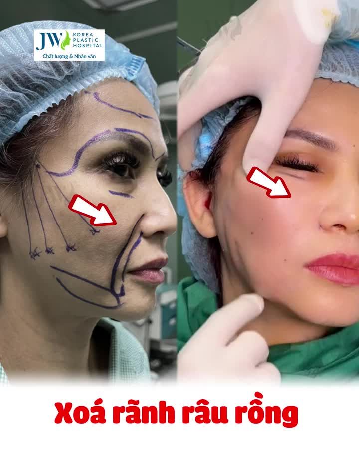 HỒI XUÂN 30 TUỔI cho Nữ Việt kiều Mỹ U60 với Combo Căng chỉ Mesh Lift + Cấy mỡ mặt