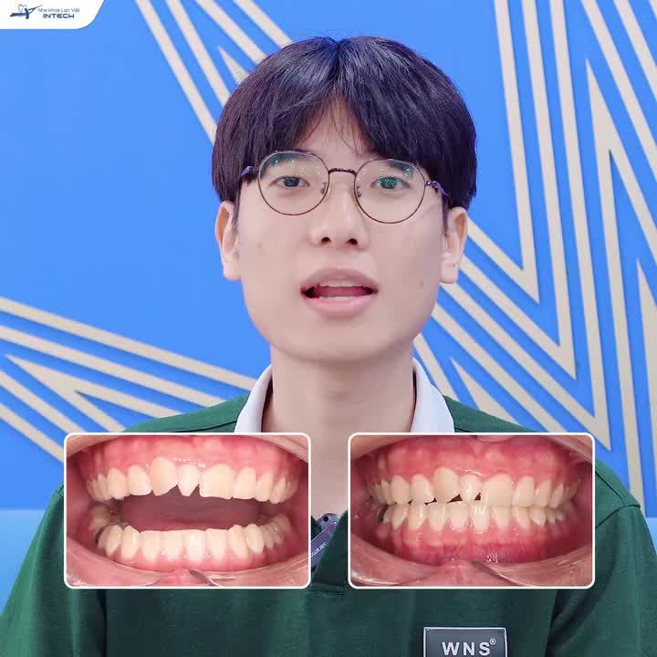 YÊN TÂM NIỀNG RĂNG VÌ ĐƯỢC BIẾT TRƯỚC “KHI NÀO SẼ ĐẸP TRAI”!