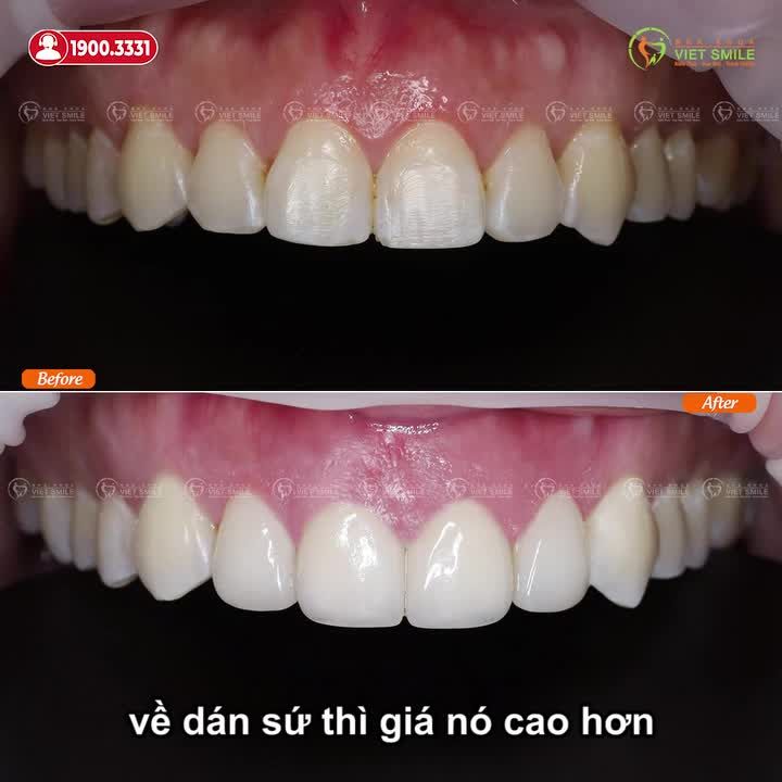 ĐỊNH CƯ TẠI PHILIPPINES NHƯNG CHỌN VIET SMILE DÁN VENEER