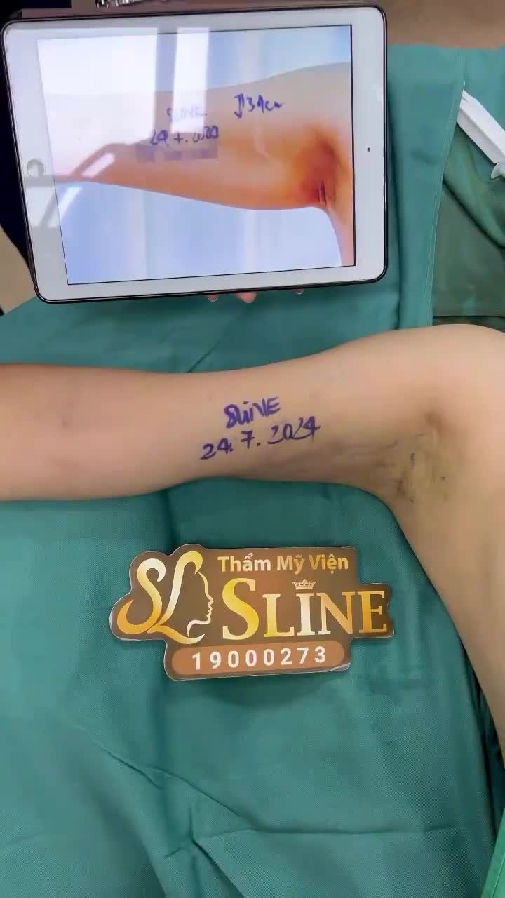 31 và 29,5...Là size tay Sline thu về ngày trước khi khách hàng thực hiện HÚT MỠ CÁNH TAY!