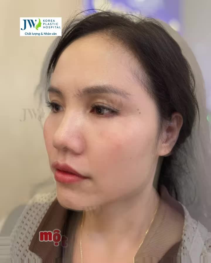 SỞ HỮU ngay làn da SĂN CHẮC, TĂNG SINH COLLAGEN sau 1 liệu trình Trẻ hóa da HIFU tại JW Luxury