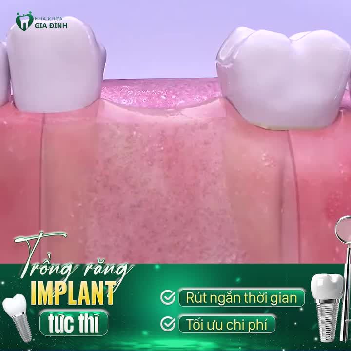 TRỒNG RĂNG IMPLANT TỨC THÌ: RÚT NGẮN THỜI GIAN - TỐI ƯU CHI PHÍ