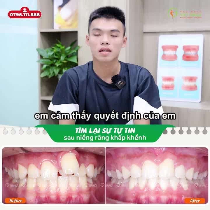 CÁN ĐÍCH NỤ CƯỜI TỰ TIN SAU NIỀNG RĂNG KHẤP KHỂNH