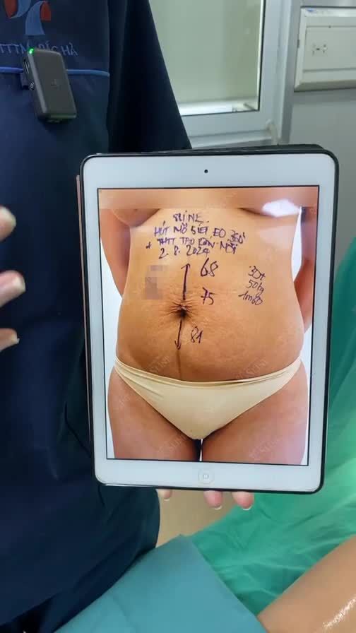 "BIẾN HÌNH" VÒNG 2 VỚI HÚT MỠ SIẾT EO 360 + THTT TẠO RỐN MỚI