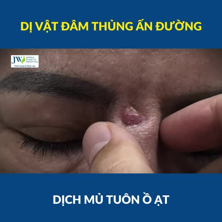 Chị gái Bình Dương KHÓC THÉT nâng mũi DỎM dị vật ĐÂM THỦNG ấn đường, XUYÊN trán MỦ DỊCH ồ ạt