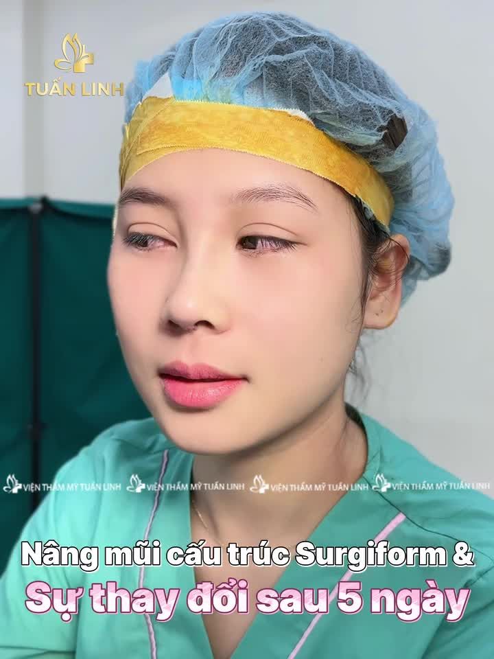 "KHÁC BIỆT TO LỚN" KHI SỞ HỮU DÁNG MŨI ƯNG Ý!!